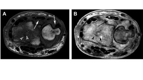 Postoperative Imaging of the Wrist and Hand
