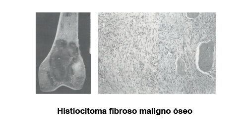 Histiocitoma fibroso maligno óseo
