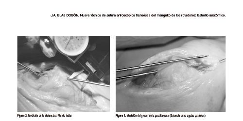 Nueva técnica de sutura artroscópica transósea del manguito de los rotadores: Estudio anatómico
