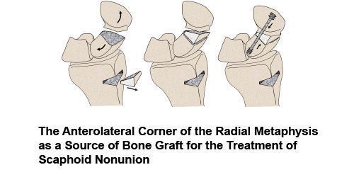 The Anterolateral Corner of the Radial Metaphysis as a Source of Bone Graft for the Treatment of Scaphoid Nonunion