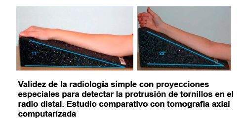 Validez de la radiología simple con proyecciones especiales para detectar la protrusión de tornillos en el radio distal. Estudio comparativo con tomografía axial computarizada