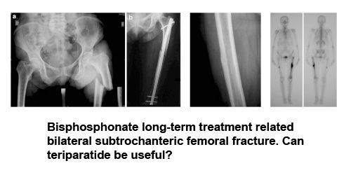 Bisphosphonate long-term treatment related bilateral subtrochanteric femoral fracture. Can teriparatide be useful?