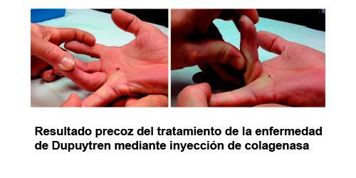 Resultado precoz del tratamiento de la enfermedad de Dupuytren mediante inyección de colagenasa