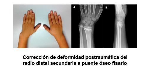 Corrección de deformidad postraumática del radio distal secundaria a puente óseo fisario