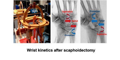 Wrist kinetics after scaphoidectomy