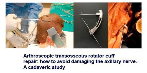 Arthroscopic transosseous rotator cuff repair: how to avoid damaging the axillary nerve. A cadaveric study