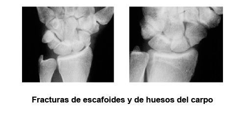 Fracturas de escafoides y de huesos del carpo