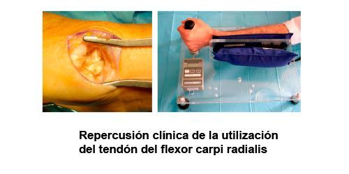 Repercusión clínica de la utilización del tendón del flexor carpi radialis en Valencia