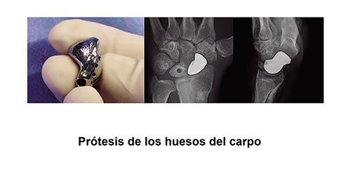 Prótesis de los huesos del carpo en Valencia