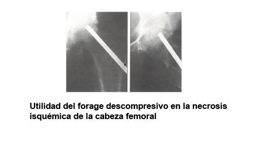 Utilidad del forage descompresivo en la necrosis isquémica de la cabeza femoral