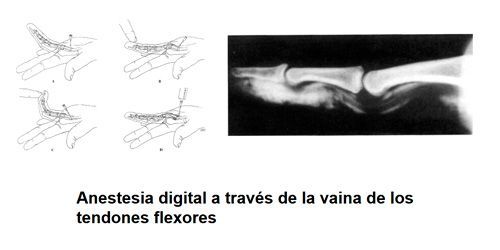Cirugía de los tendones felxores en Valencia