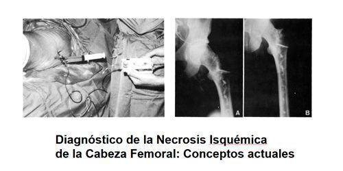 Cirugía dela cabeza femoral en Valencia