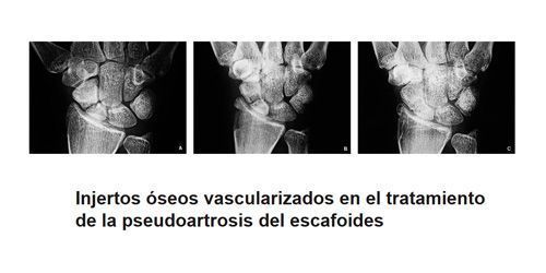 Injertos óseos en Valencia