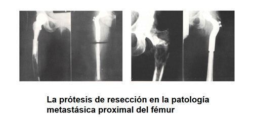 Cirugía del femur en Valencia