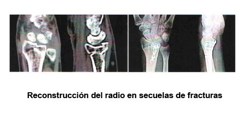 Reconstrucción del radio en secuelas de fracturas