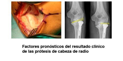 Factores pronósticos del resultado clínico de las prótesis de cabeza de radio