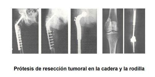 Prótesis de resección tumoral en la cadera y la rodilla