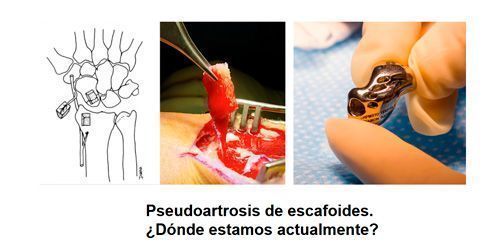 Pseudoartrosis de escafoides en Valencia