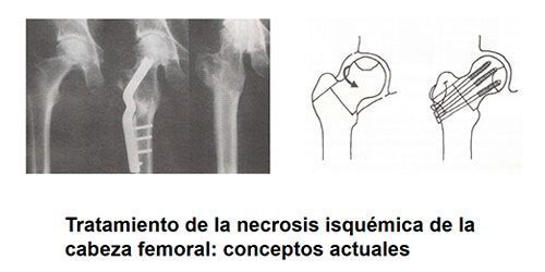 Necrosis isquémica de la cabeza femoral.