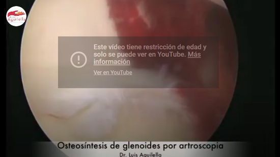 video osteosintesis